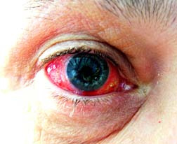 AMO infected eye