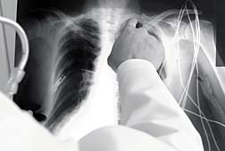Asbestosis Lung Disease