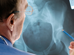 Depo-Provera Side Effects Can Include Osteoporosis